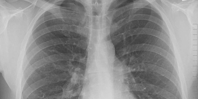 Pasif içicilerde "akciğer kanseri" riski